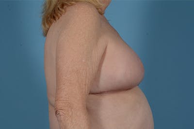 Breast Lift Before & After Gallery - Patient 146779805 - Image 6