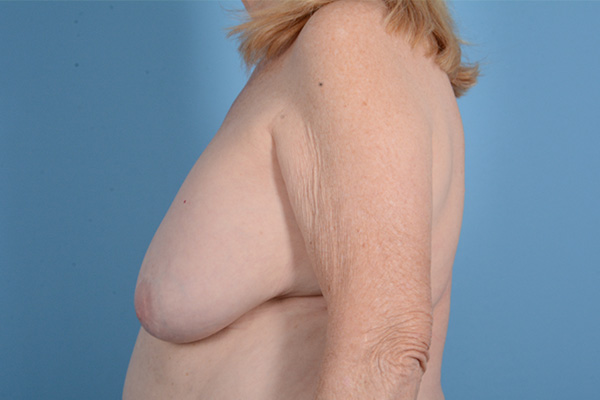 Breast Lift Before & After Gallery - Patient 146779805 - Image 9