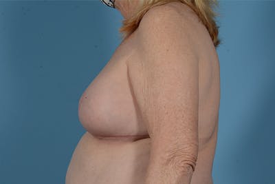 Breast Lift Before & After Gallery - Patient 146779805 - Image 10