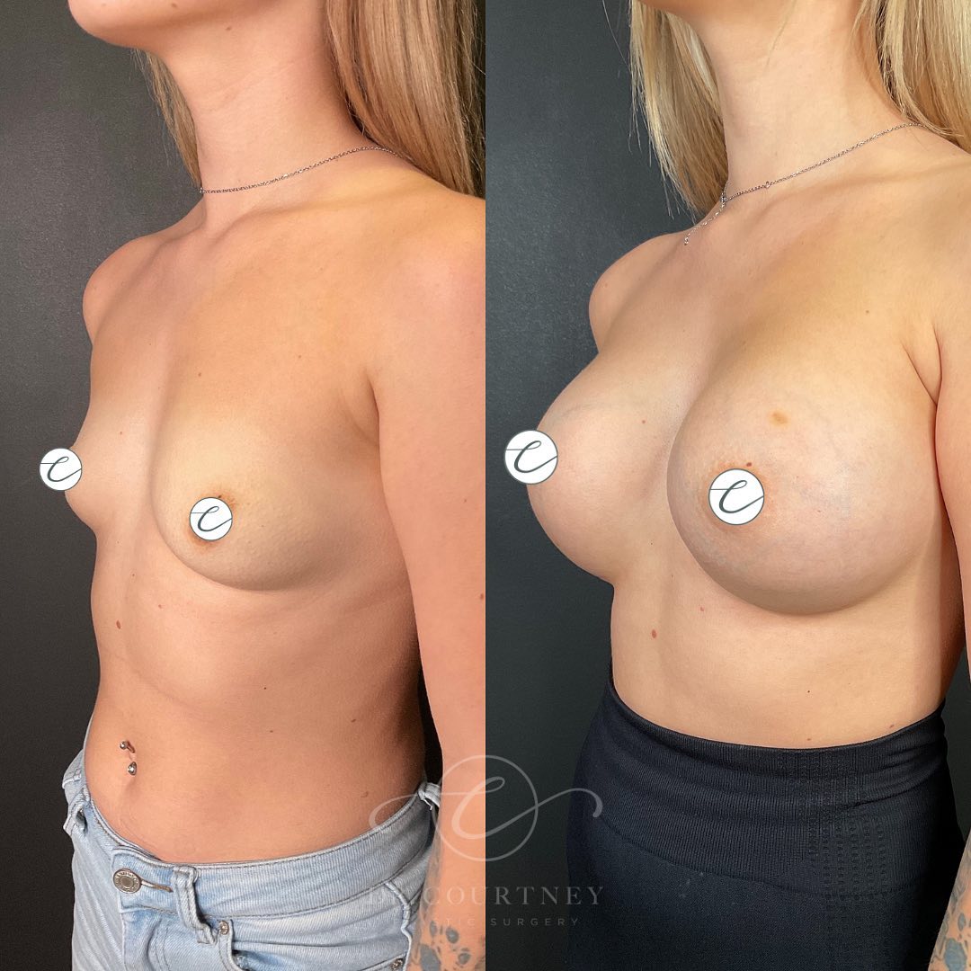 Breast Augmentation Before & After Gallery - Patient 148073445 - Image 2