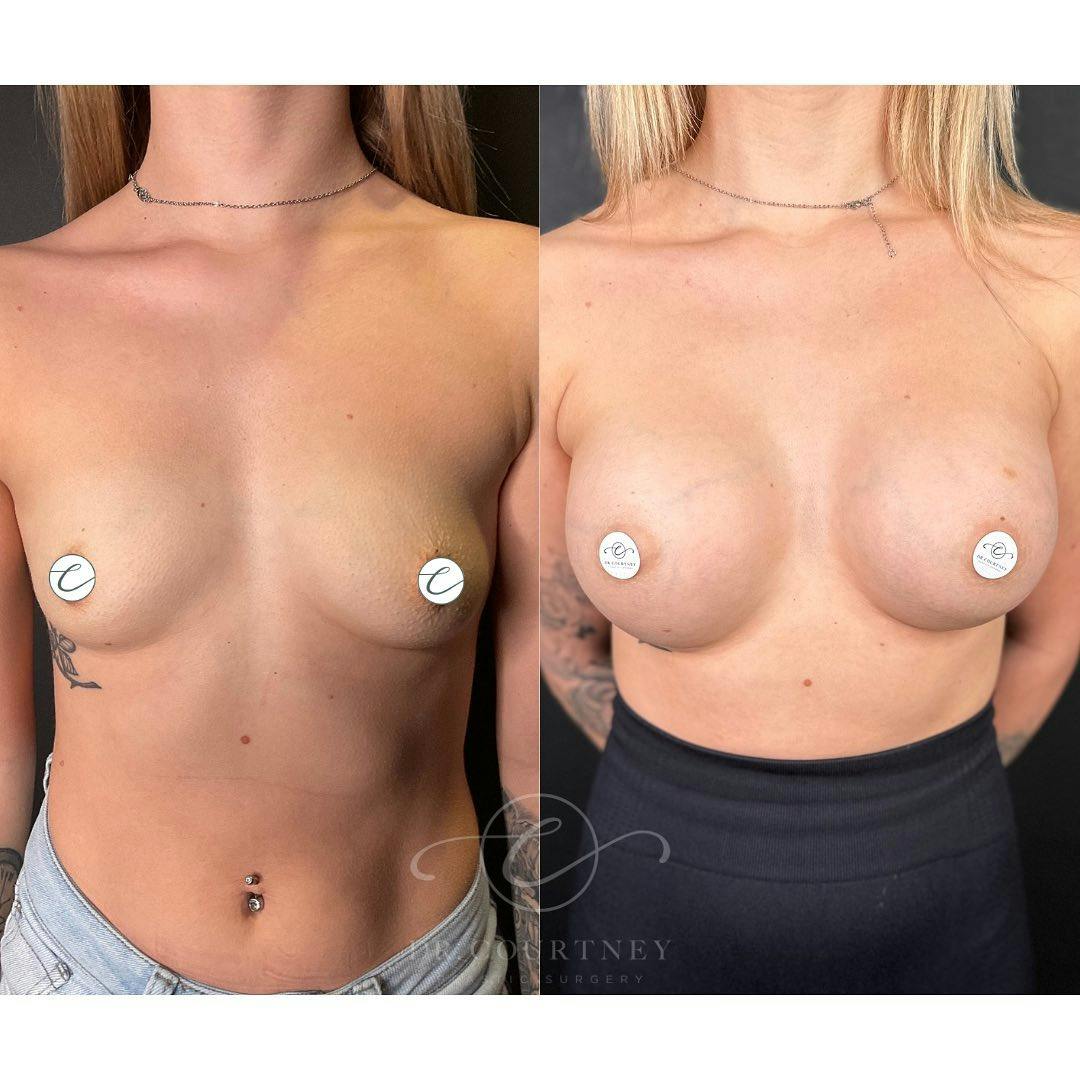 Breast Augmentation Before & After Gallery - Patient 148073445 - Image 1