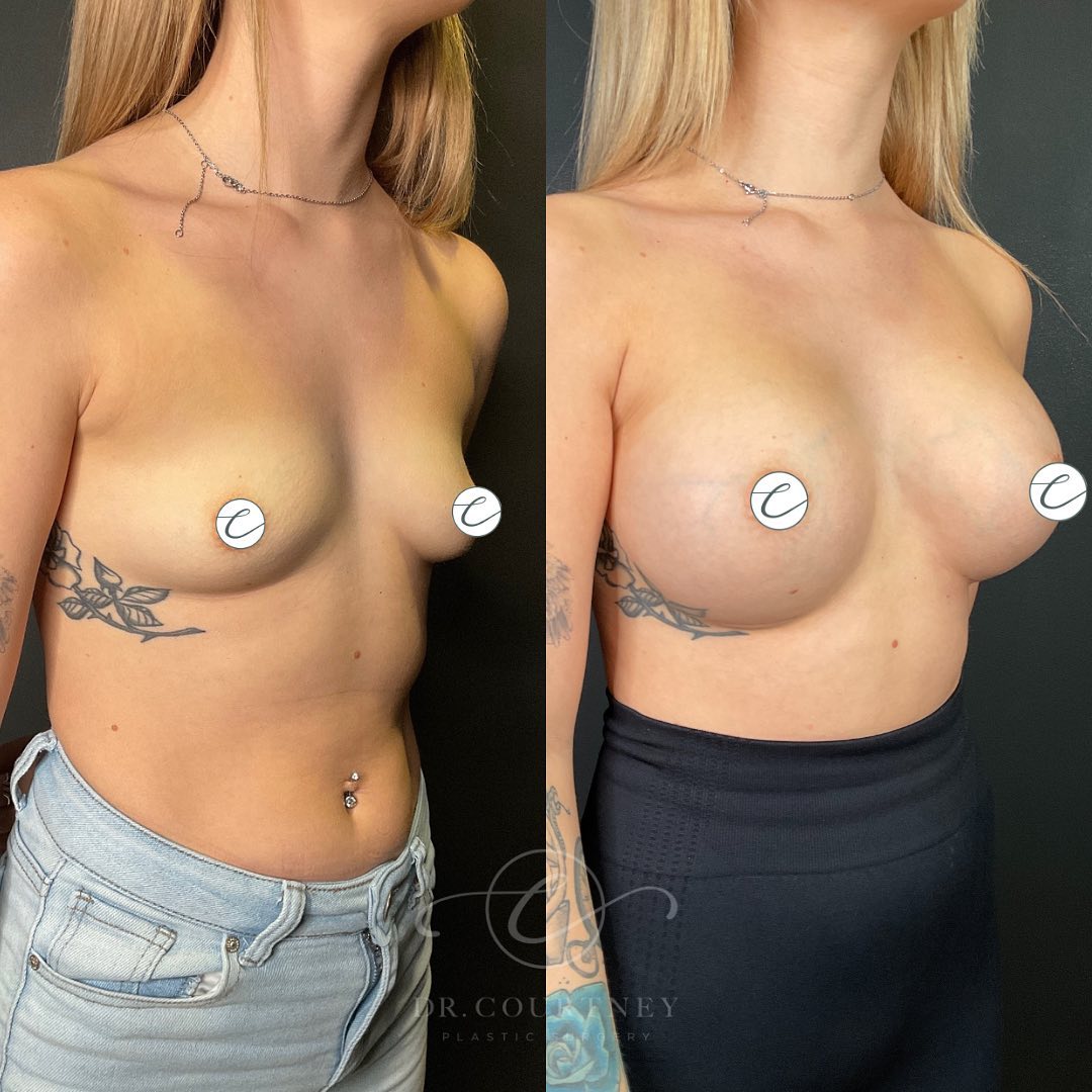 Breast Augmentation Before & After Gallery - Patient 148073445 - Image 3