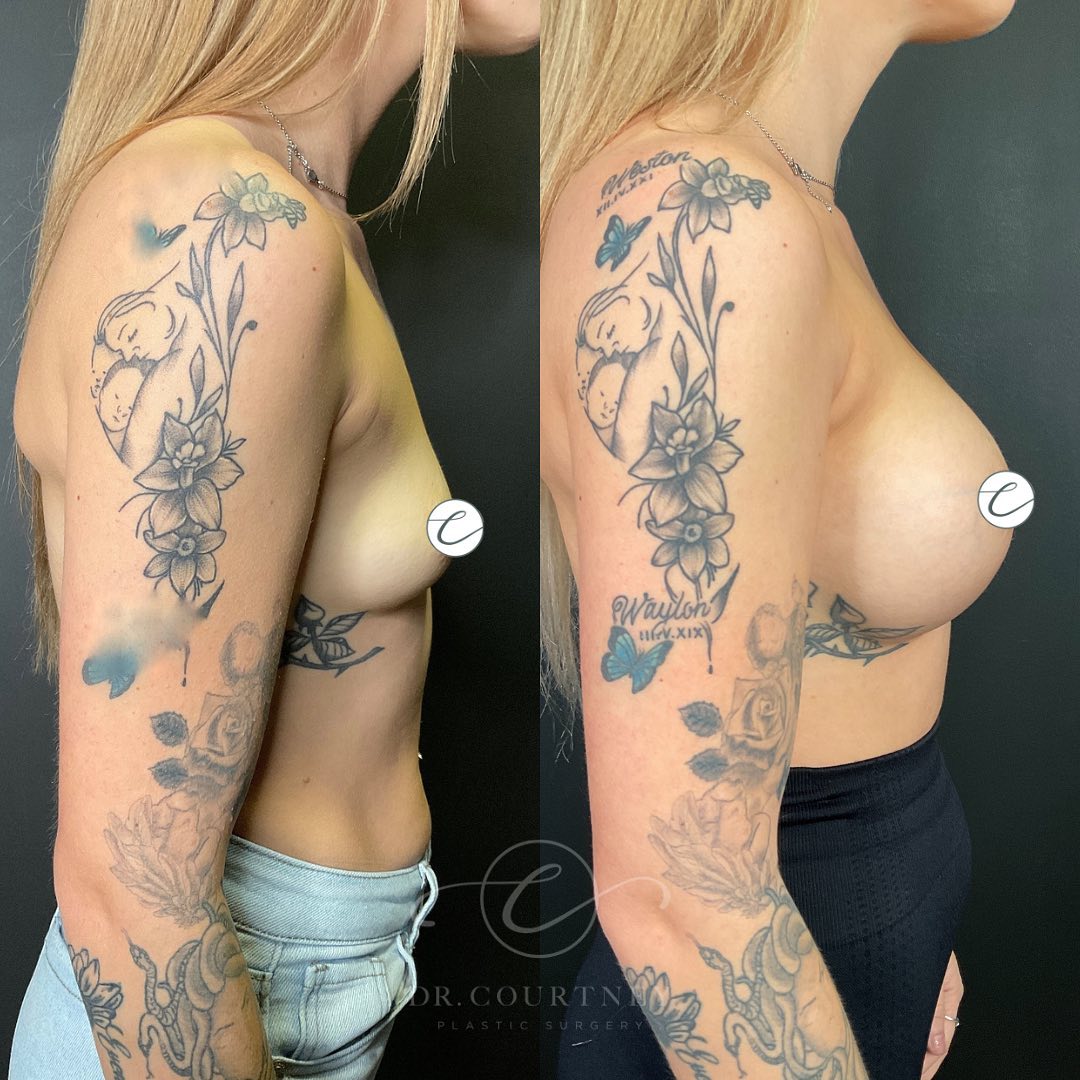 Breast Augmentation Before & After Gallery - Patient 148073445 - Image 4