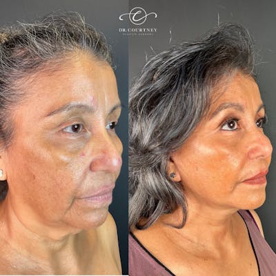 Facelift Before & After Gallery - Patient 148073466 - Image 1