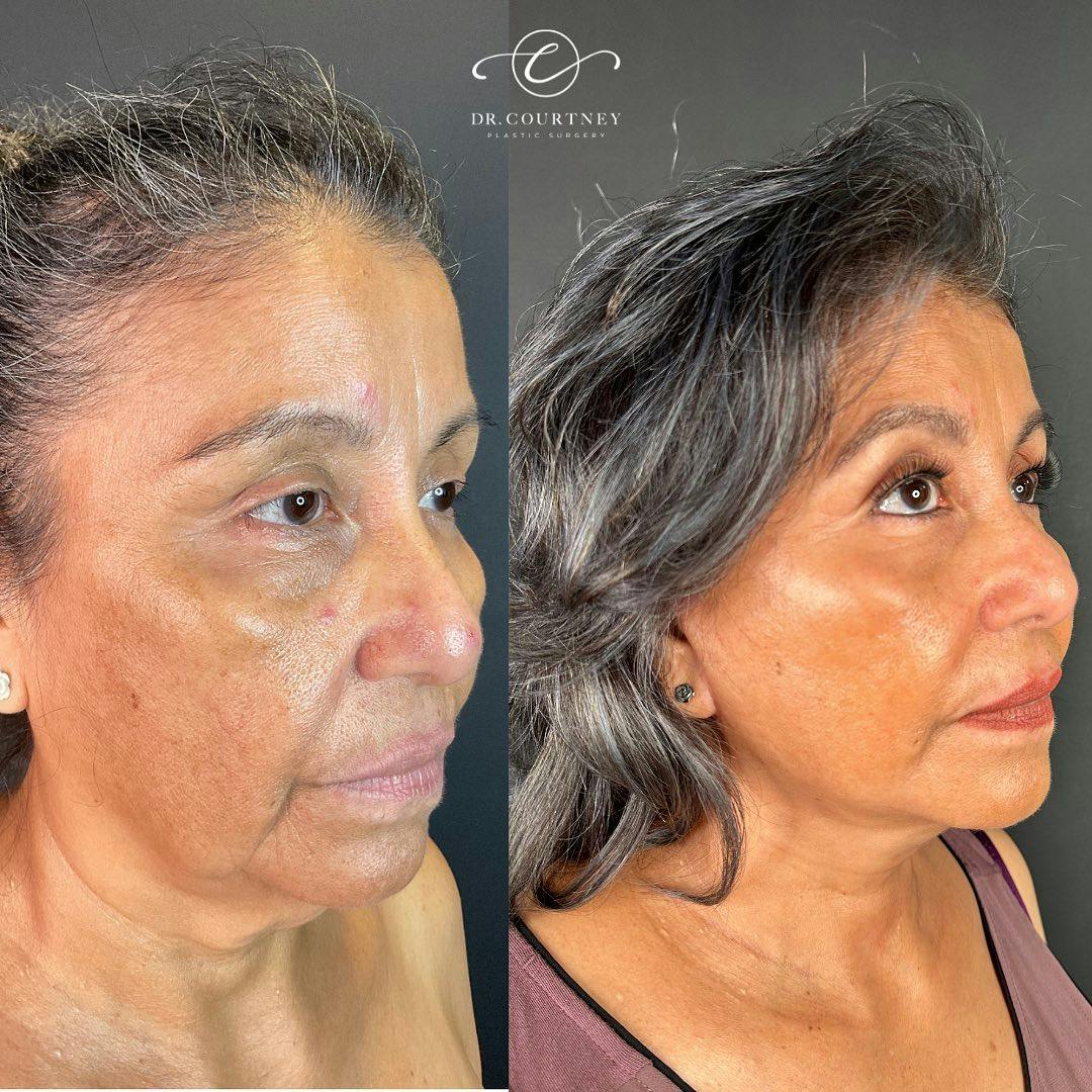 Facelift Before & After Gallery - Patient 148073466 - Image 1