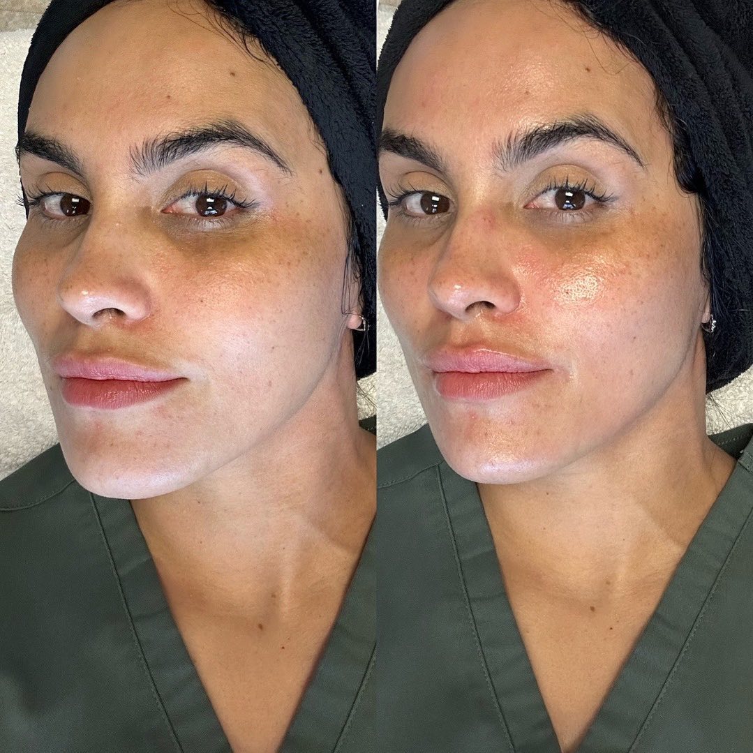 before and after side profile of patient after their hydrafacial