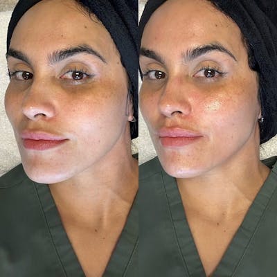 Hydrafacial Before & After Gallery - Patient 148073476 - Image 1