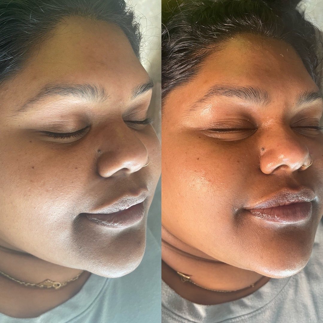 Hydrafacial Before & After Gallery - Patient 148073494 - Image 1