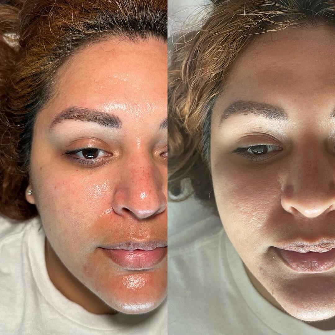 Hydrafacial Before & After Gallery - Patient 148073495 - Image 1
