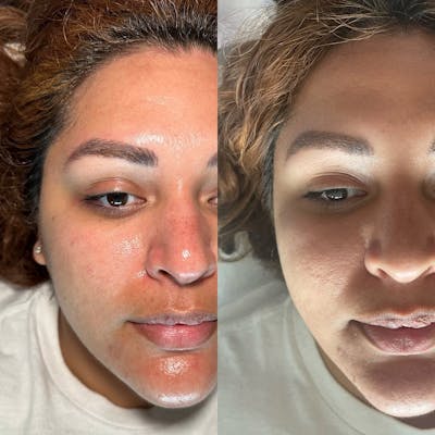 Hydrafacial Before & After Gallery - Patient 148073495 - Image 1