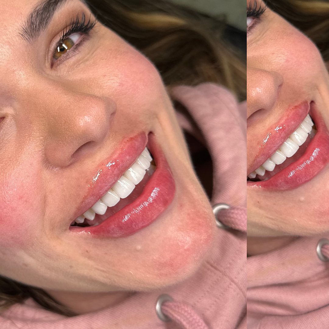 Lip Fillers Before & After Gallery - Patient 148073507 - Image 1