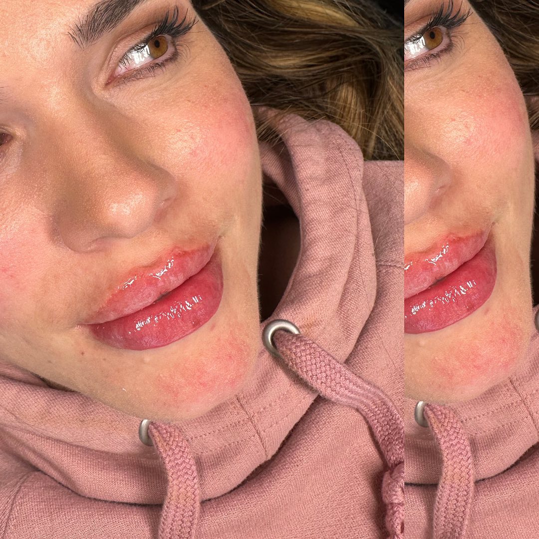 Lip Fillers Before & After Gallery - Patient 148073507 - Image 2