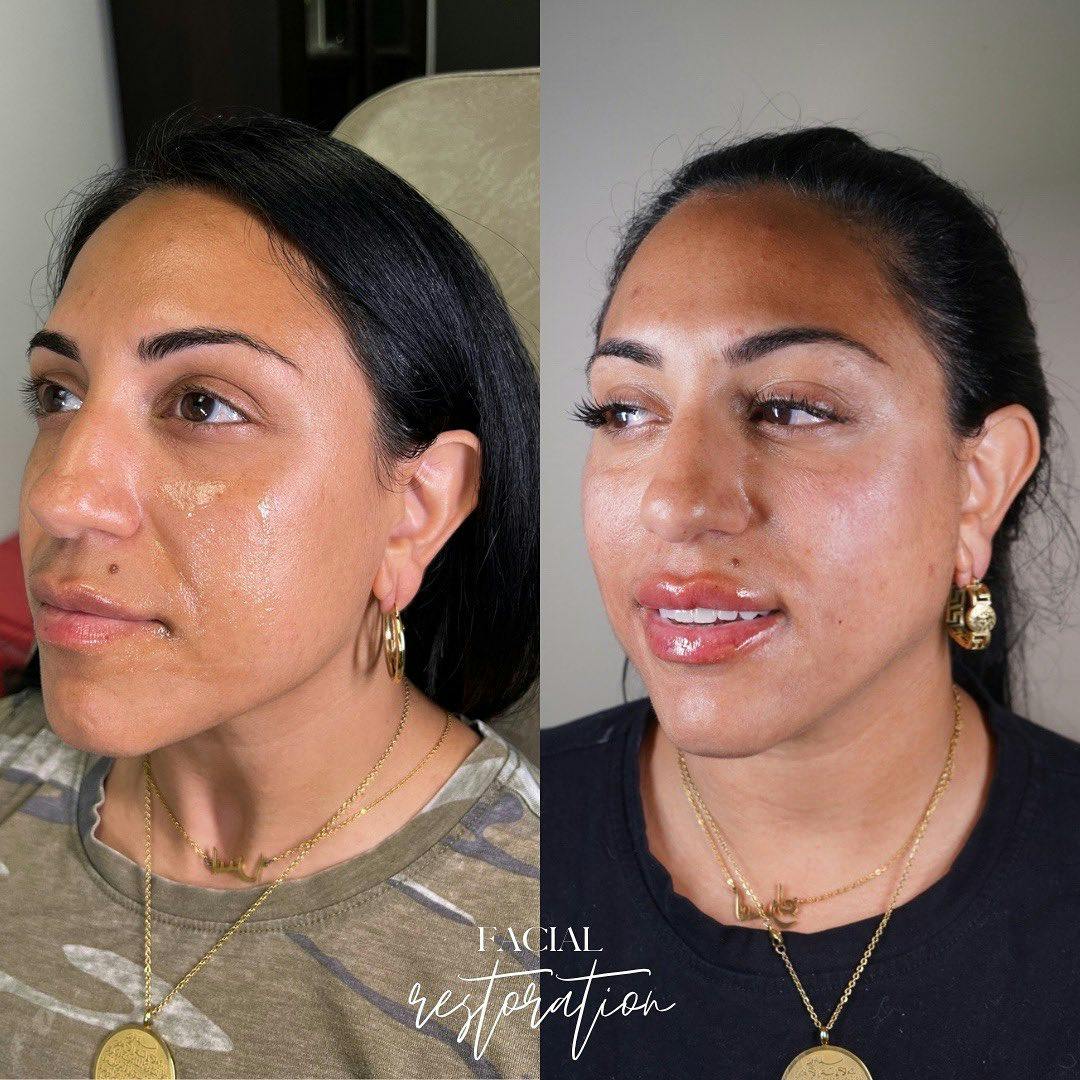 Facial Rejuvenation (Facial Balancing)  Before & After Gallery - Patient 148073517 - Image 1
