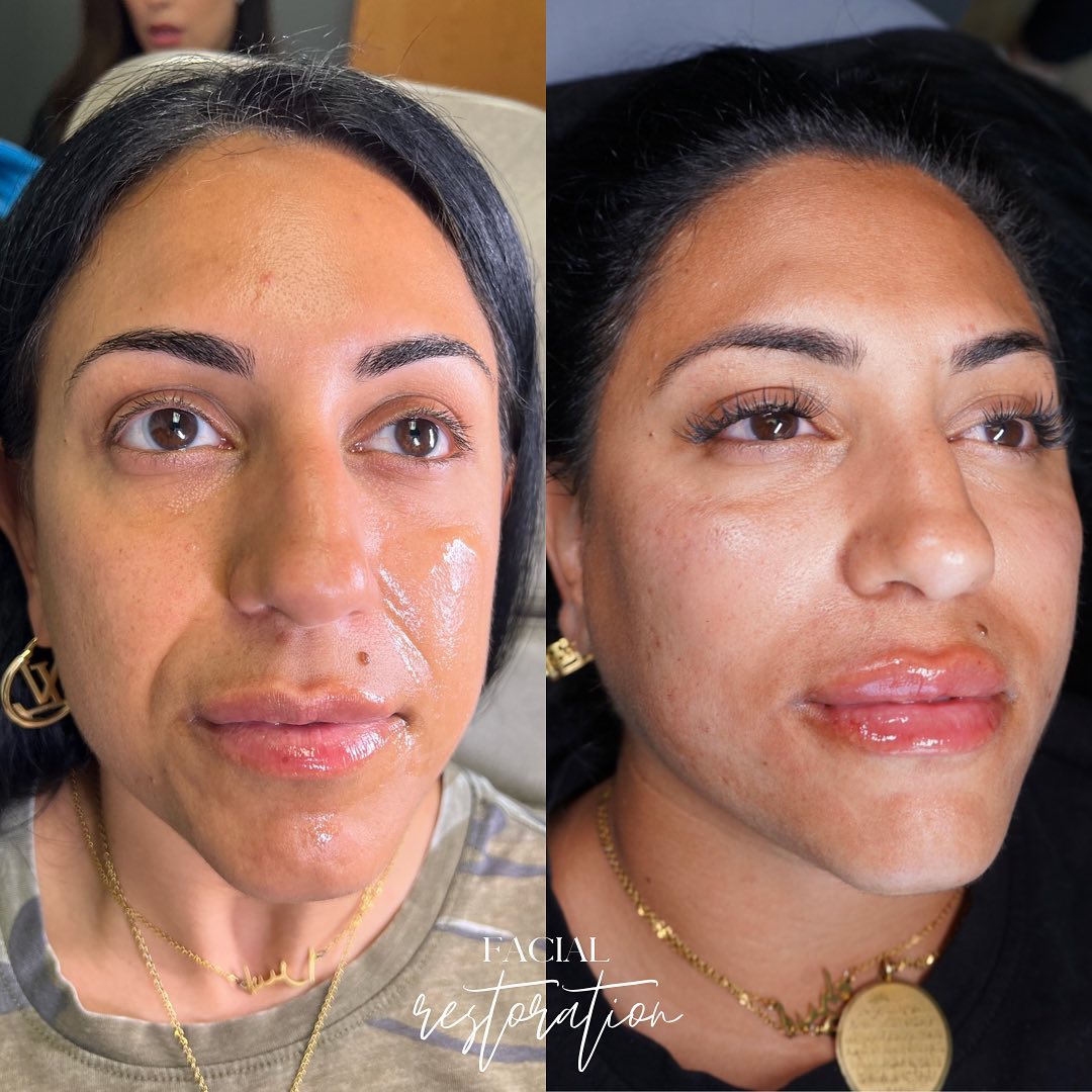 Facial Rejuvenation Before & After Gallery - Patient 148073517 - Image 2