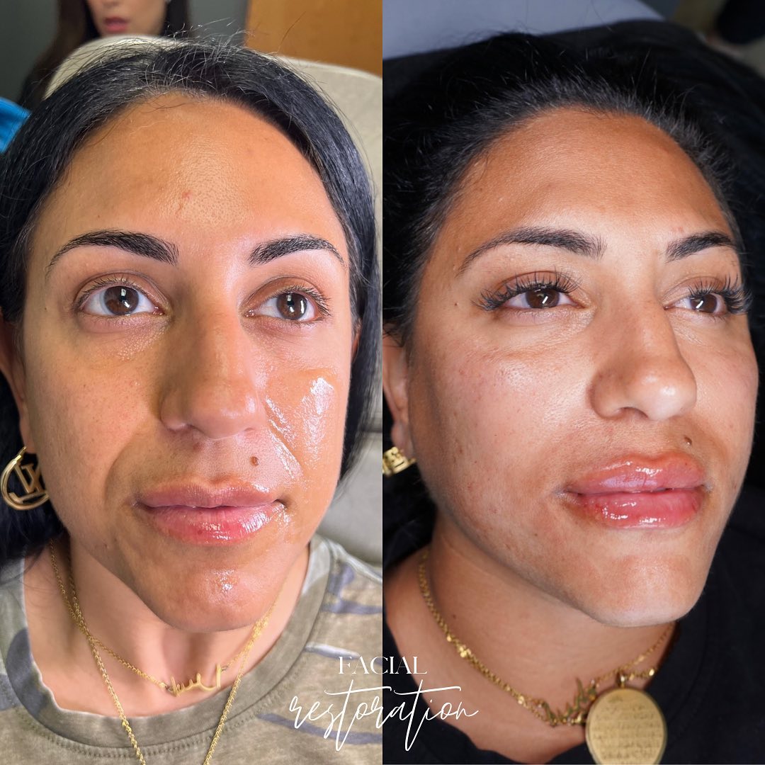 Facial Rejuvenation (Facial Balancing)  Before & After Gallery - Patient 148073517 - Image 2