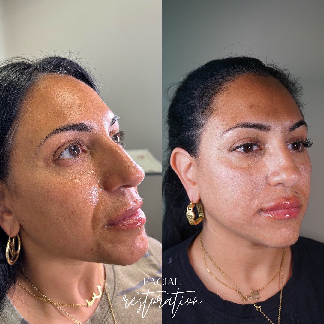 Facial Rejuvenation (Facial Balancing)  Before & After Gallery - Patient 148073517 - Image 3