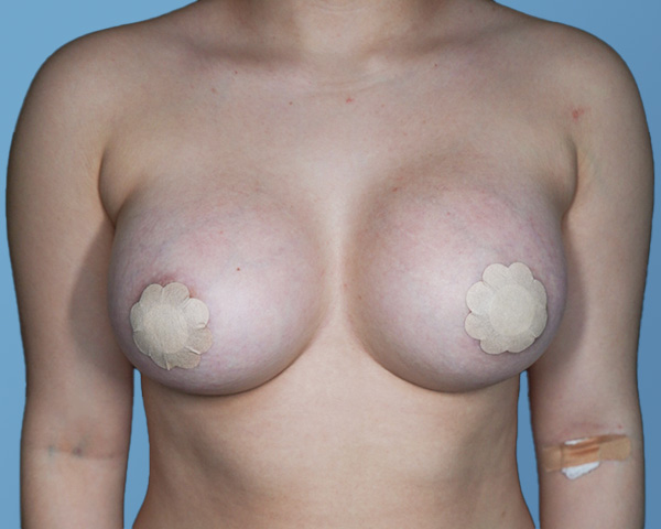Breast Augmentation Before & After Gallery - Patient 148563122 - Image 2