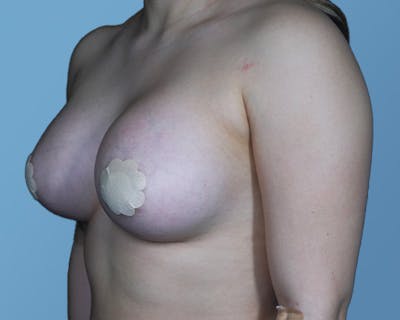Breast Augmentation Before & After Gallery - Patient 148563122 - Image 8