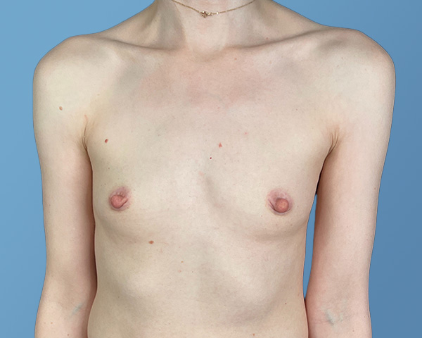Breast Augmentation Before & After Gallery - Patient 148563121 - Image 1