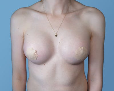 Breast Augmentation Before & After Gallery - Patient 148563121 - Image 2