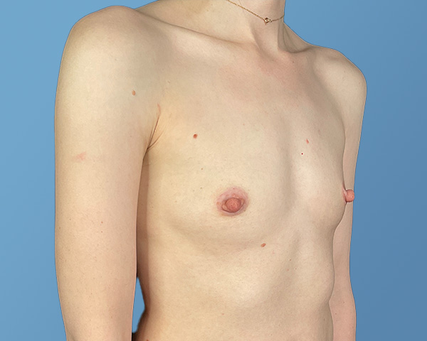 Breast Augmentation Before & After Gallery - Patient 148563121 - Image 3