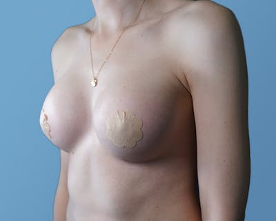 Breast Augmentation Before & After Gallery - Patient 148563121 - Image 8
