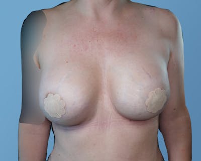 Breast Revision Before & After Gallery - Patient 148563123 - Image 2