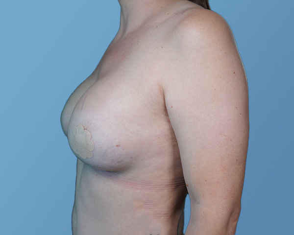 Breast Revision Before & After Gallery - Patient 148563123 - Image 6
