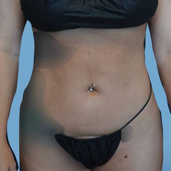 Liposuction Before & After Gallery - Patient 148563125 - Image 2