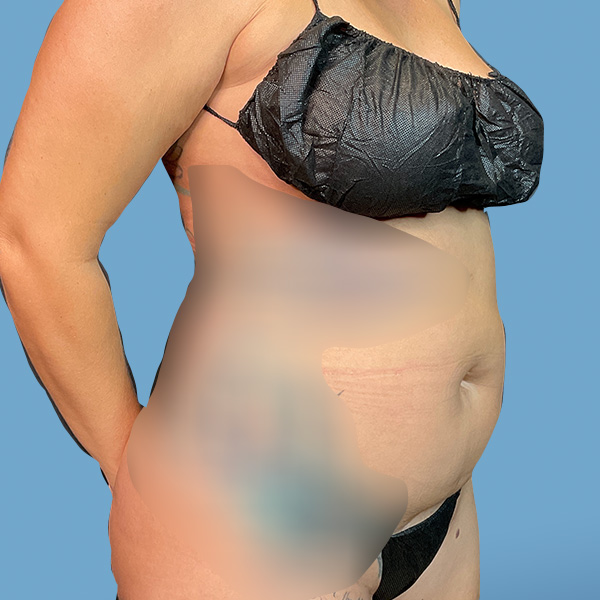 Liposuction Before & After Gallery - Patient 148563125 - Image 3
