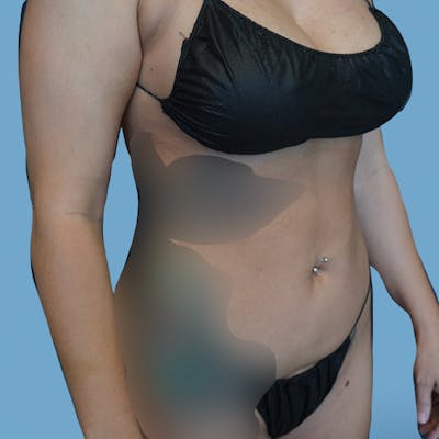 Liposuction Before & After Gallery - Patient 148563125 - Image 4