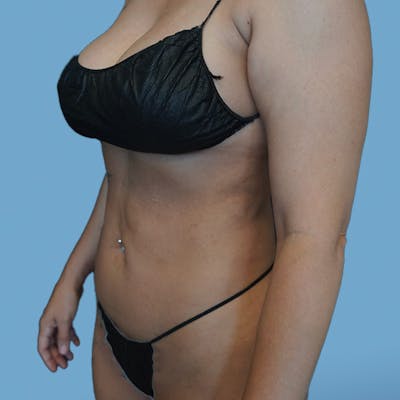 Liposuction Before & After Gallery - Patient 148563125 - Image 8