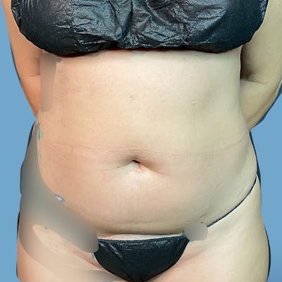 Liposuction Before & After Gallery - Patient 148563125 - Image 1