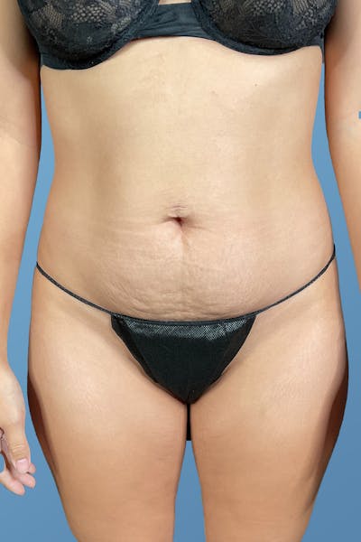 Tummy Tuck (Abdominoplasty)  Before & After Gallery - Patient 148563161 - Image 1