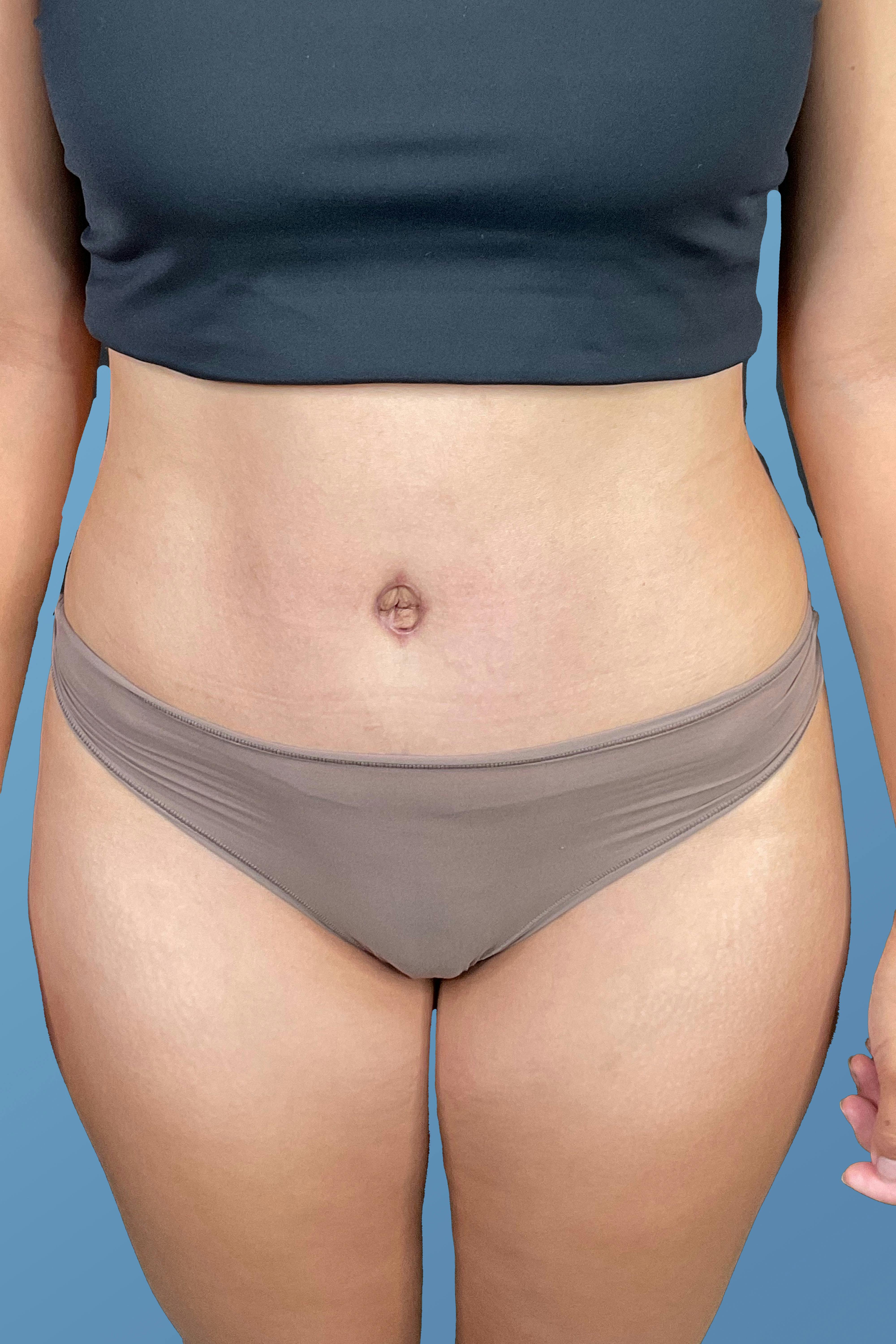 Tummy Tuck (Abdominoplasty)  Before & After Gallery - Patient 148563161 - Image 2