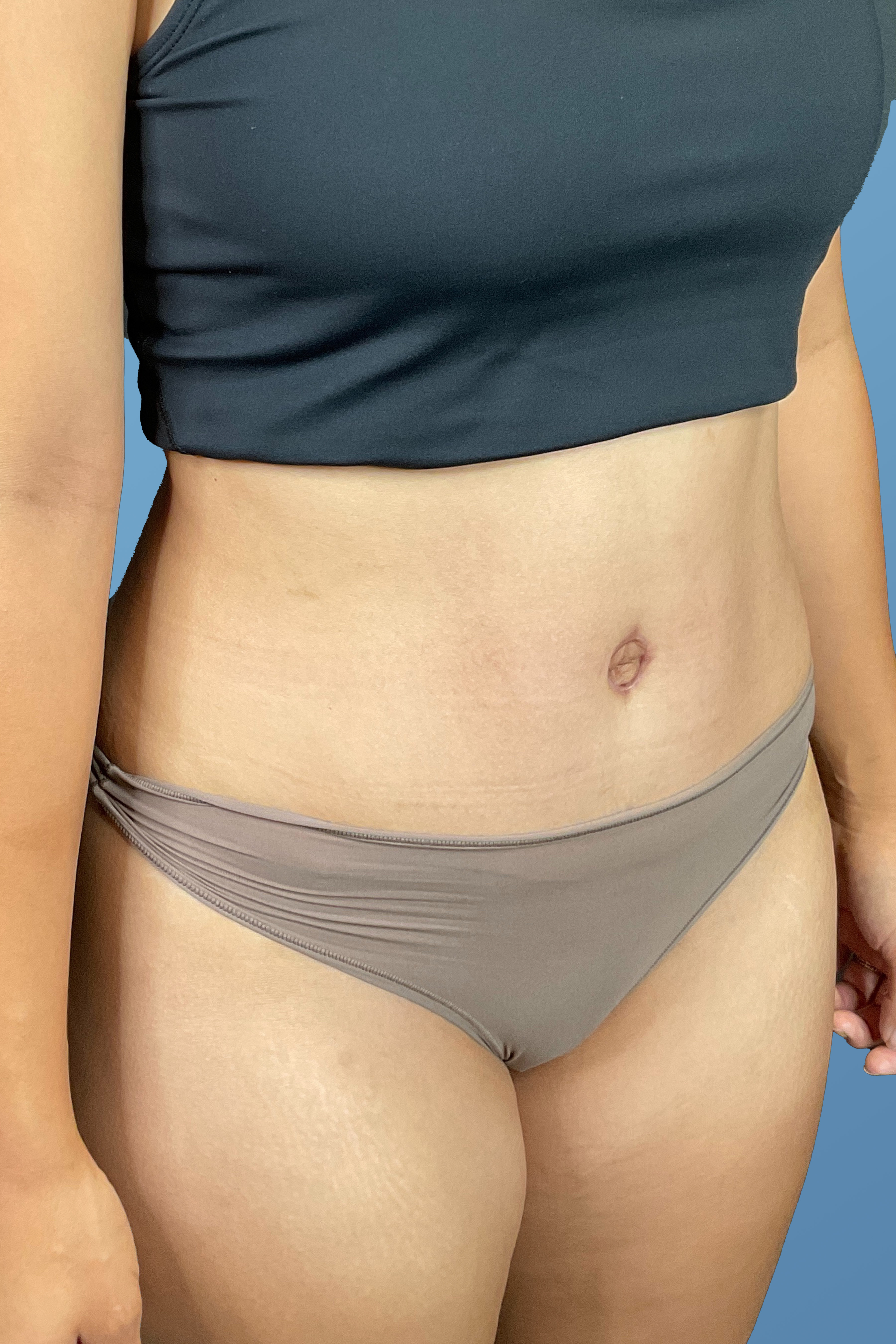 Tummy Tuck (Abdominoplasty)  Before & After Gallery - Patient 148563161 - Image 4