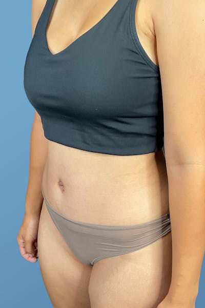 Tummy Tuck (Abdominoplasty)  Before & After Gallery - Patient 148563161 - Image 6
