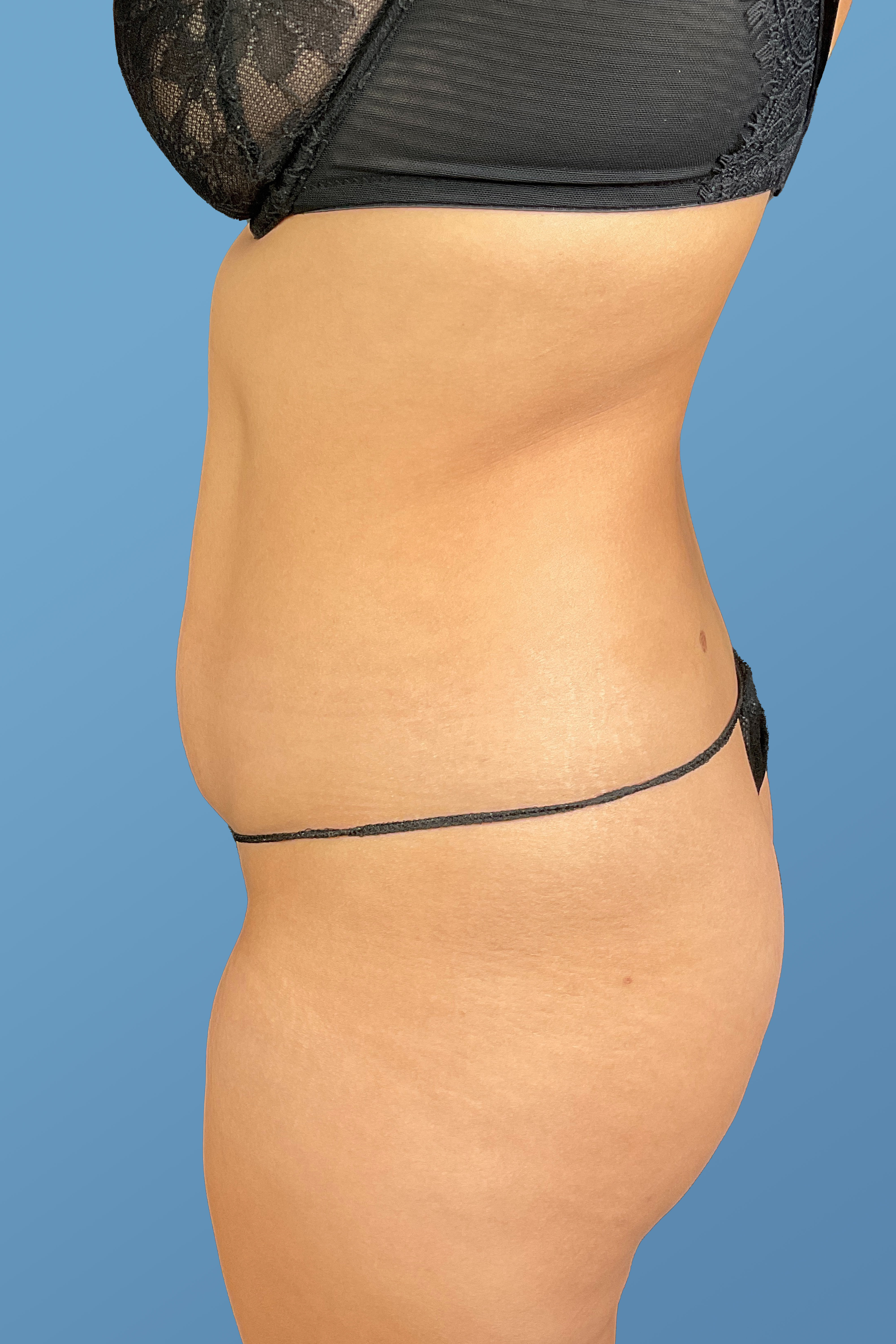 Tummy Tuck (Abdominoplasty)  Before & After Gallery - Patient 148563161 - Image 7