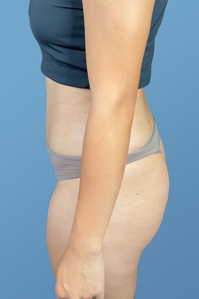 Tummy Tuck (Abdominoplasty)  Before & After Gallery - Patient 148563161 - Image 8