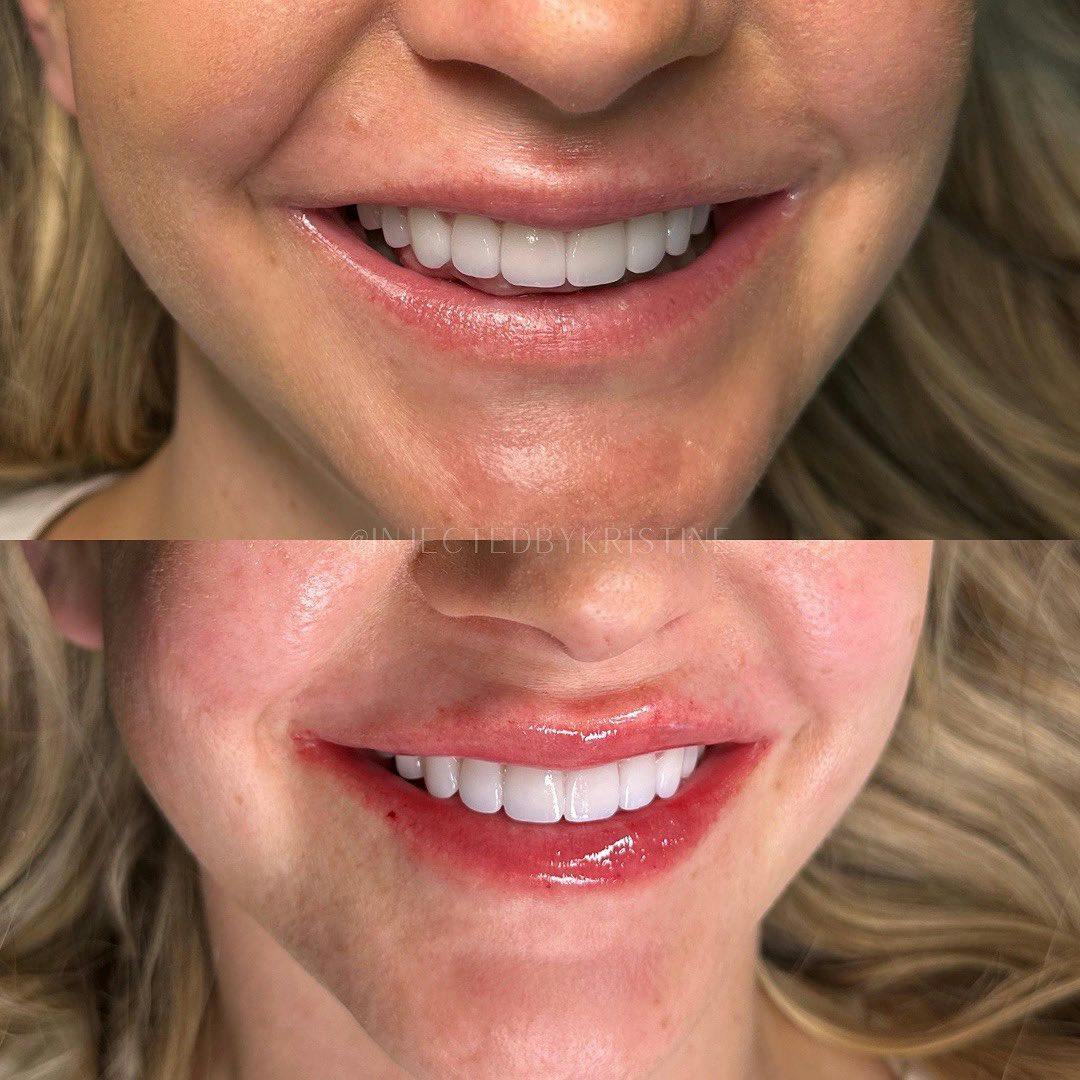 Lip Threads Before & After Gallery - Patient 148590032 - Image 1