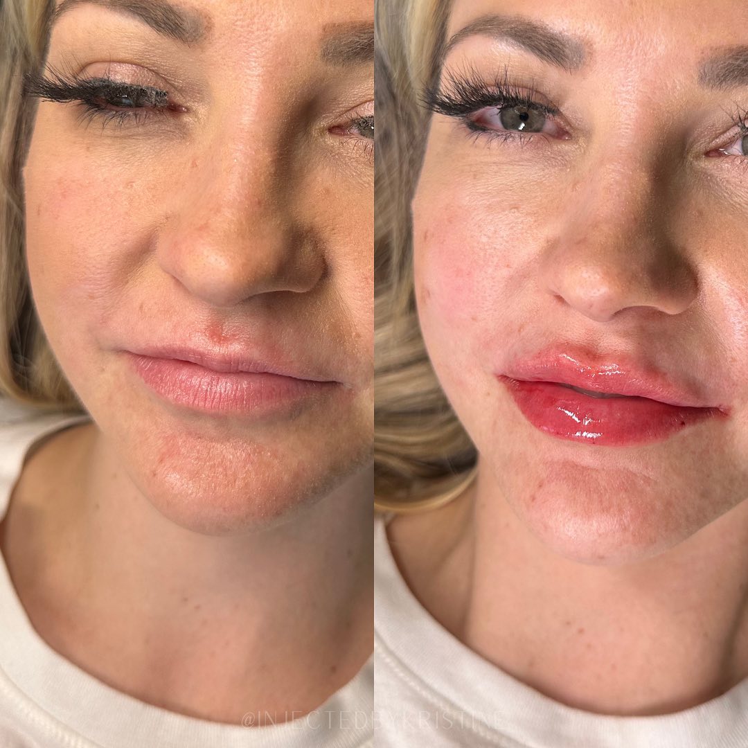 Lip Threads Before & After Gallery - Patient 148590032 - Image 2