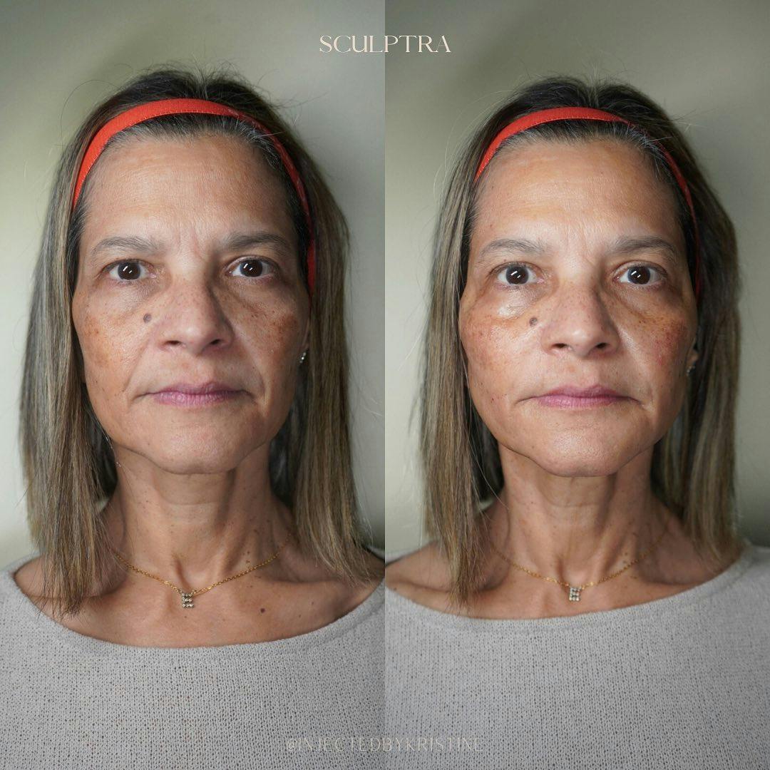 Facial Rejuvenation Before & After Gallery - Patient 148590037 - Image 1