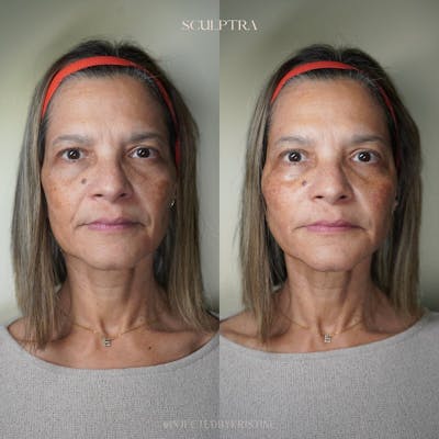 Facial Rejuvenation (Facial Balancing)  Before & After Gallery - Patient 148590037 - Image 1