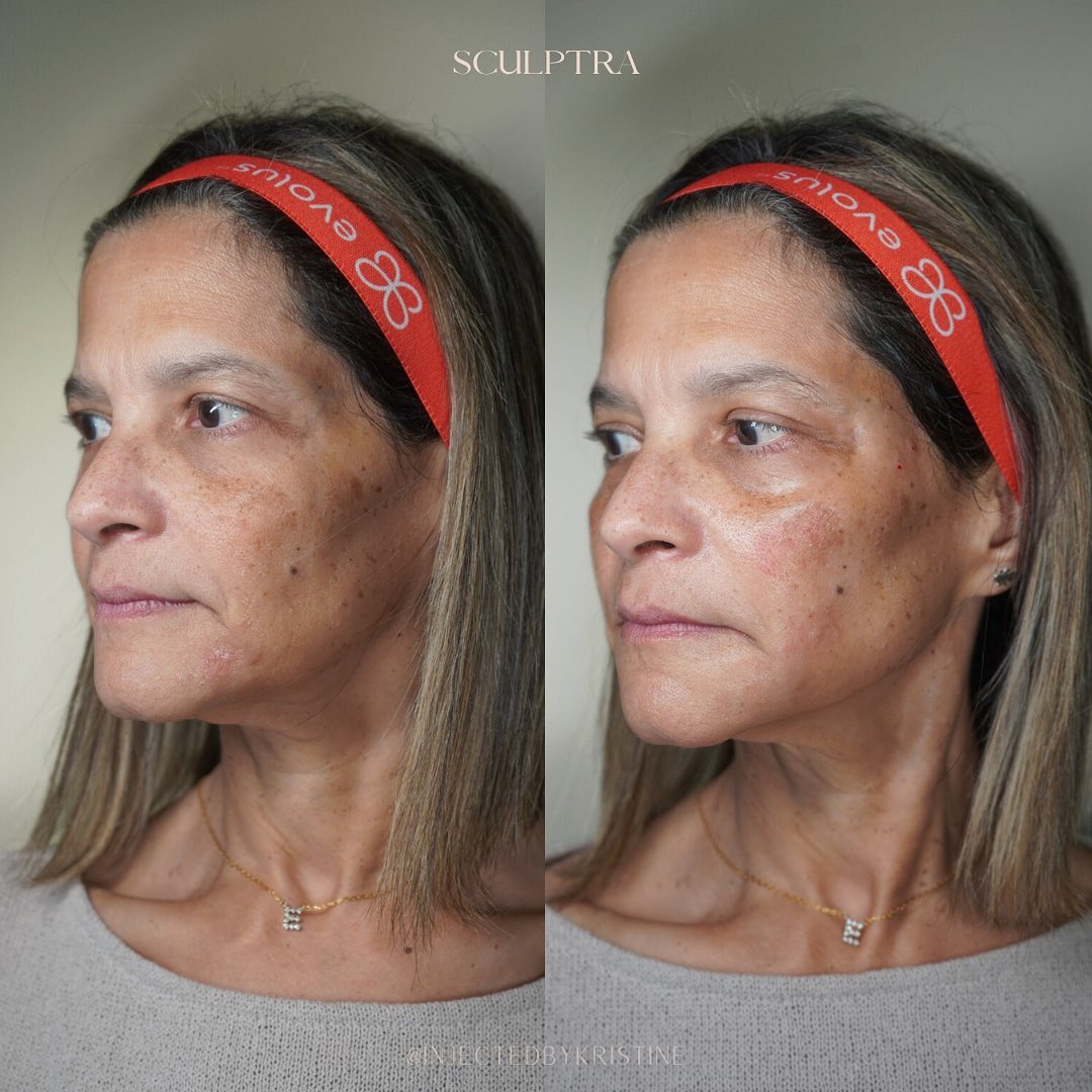 Sculptra Before & After Gallery - Patient 148590035 - Image 2