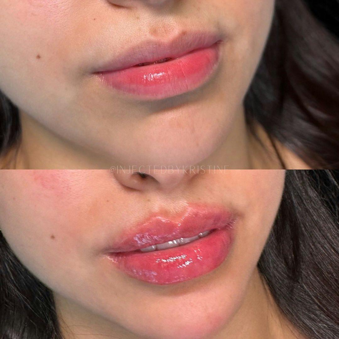 Lip Fillers Before & After Gallery - Patient 148590039 - Image 1