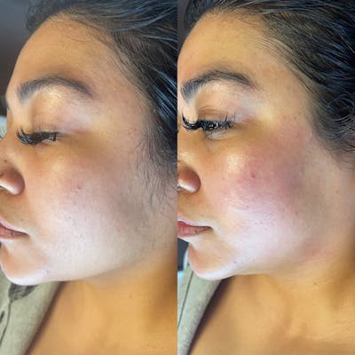 Hydrafacial Before & After Gallery - Patient 148590041 - Image 1