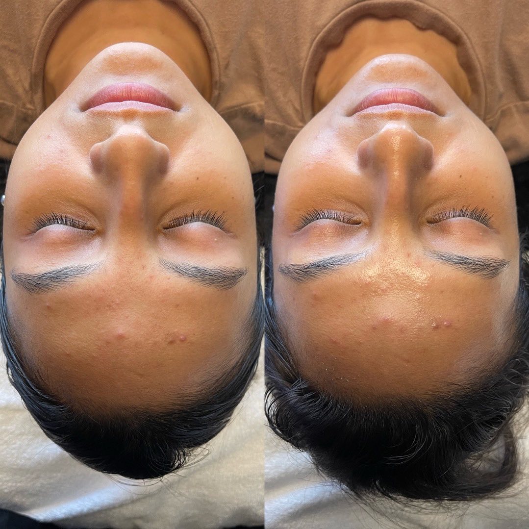 Hydrafacial Before & After Gallery - Patient 148590042 - Image 1