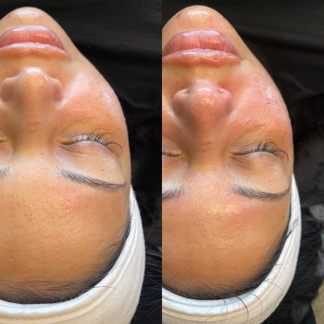 Hydrafacial Before & After Gallery - Patient 148590049 - Image 1