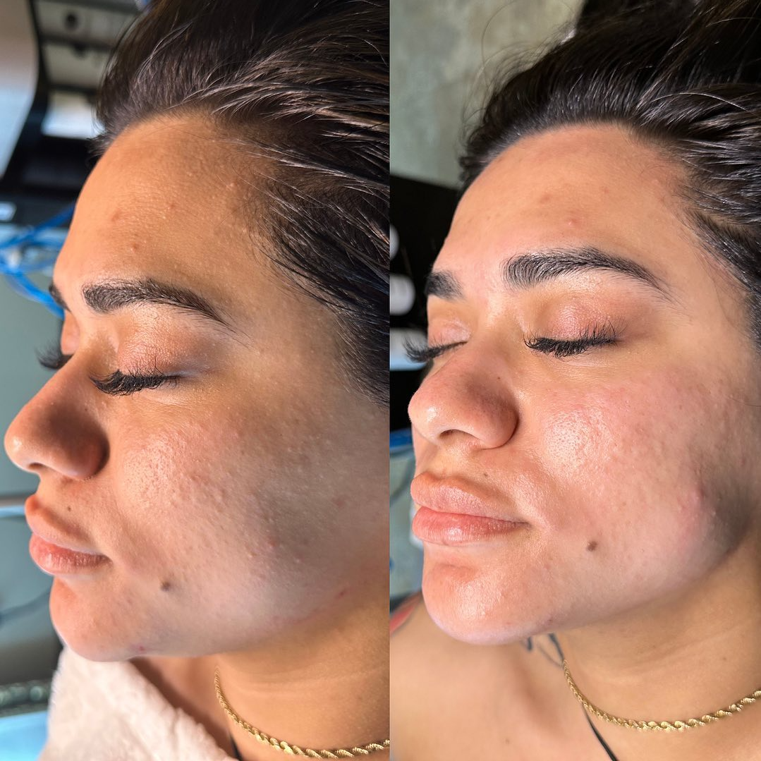 before and after side profile of patient after their hydrafacial treatment