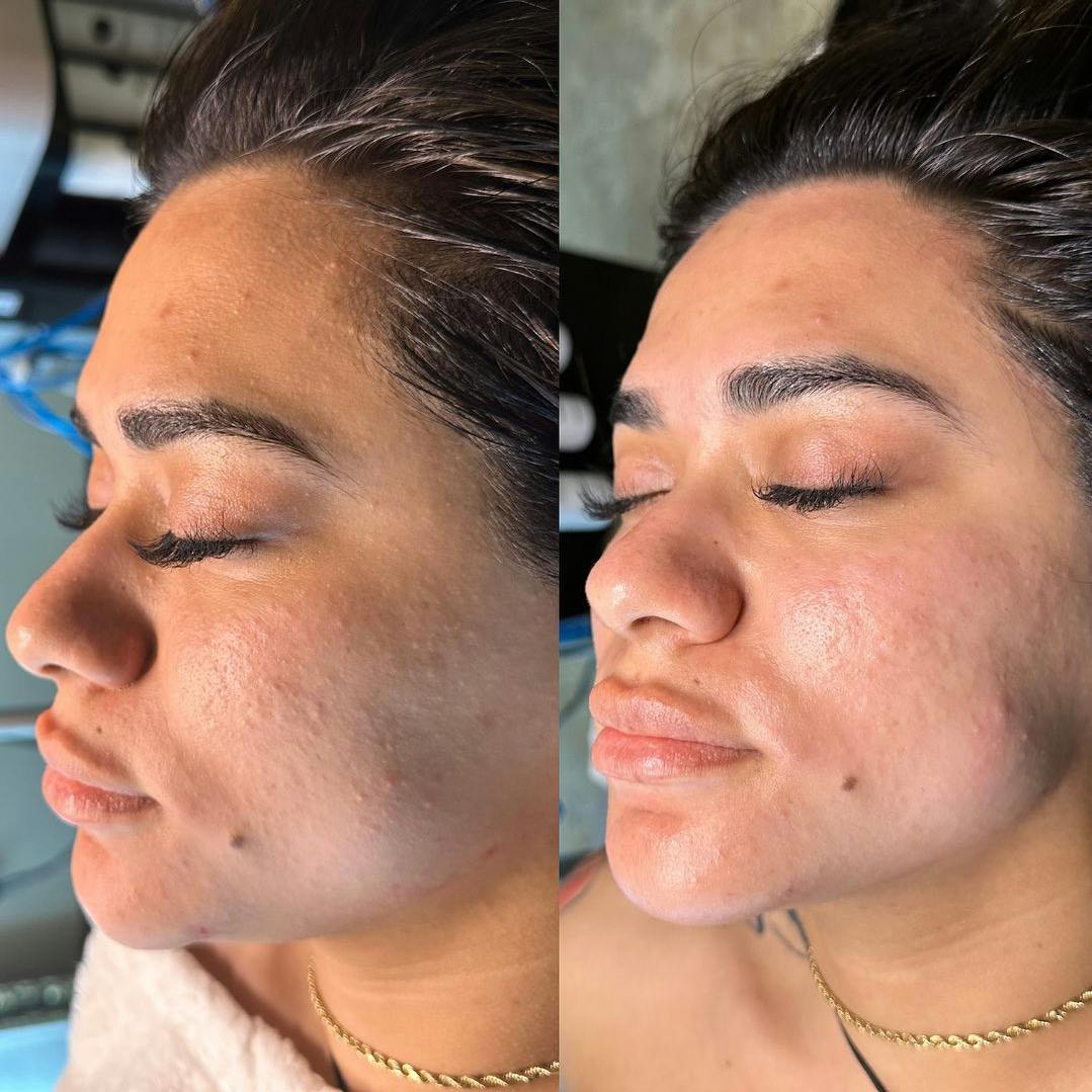 before and after side profile of patient after their hydrafacial treatment